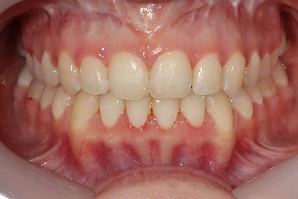 Post braces, Open bite closed