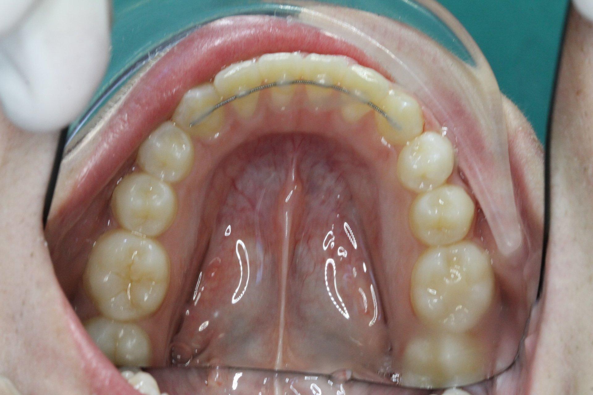 Lower arch after treatment with braces and fixed retainer placed