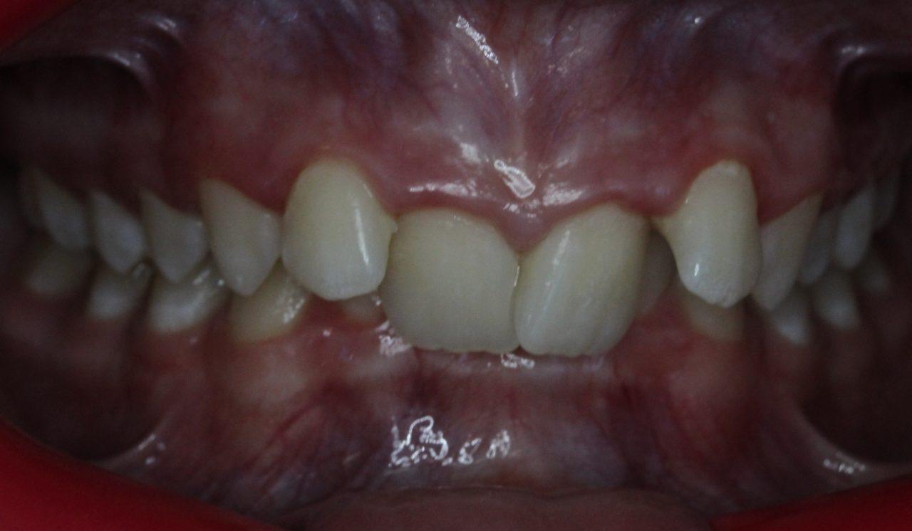 Deep bite associated with severe crowding (Pre treatment), lower teeth cannot be visualised in bite