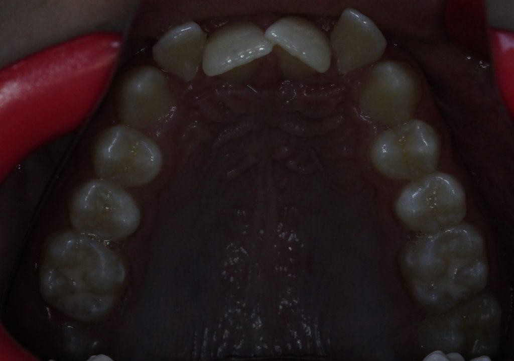 Before Treatment upper arch (severe crowding)