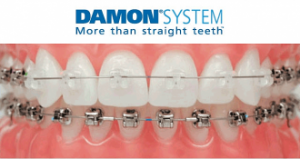 damon-system Damon Braces