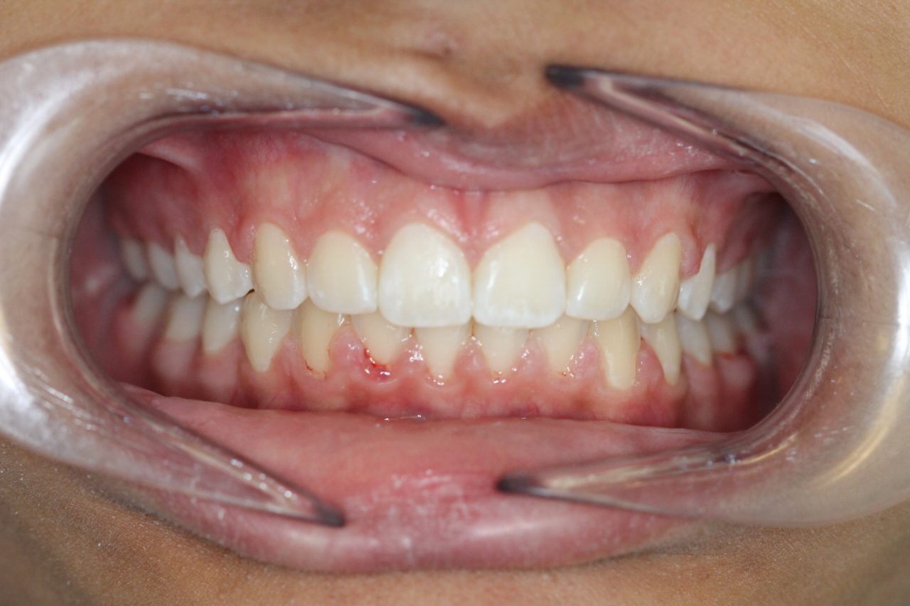 After braces, wider arch , ideal overjet and overbite, no crowding