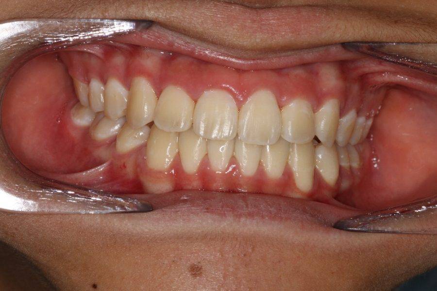 Post Braces:  Ideal overjet, overbite and centre lines