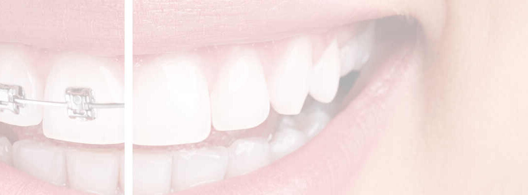 DAMON BRACES: WHAT THE ABSOLUTE MYSTERY ARE THEY?