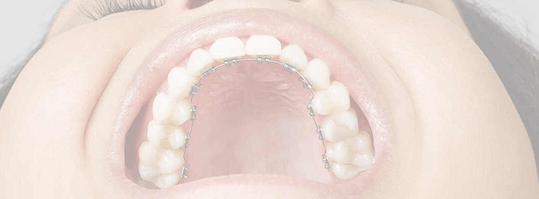 TREATMENT OF LARGE OVERJET AND OVERBITE: CASE TREATED BY DR ANAND