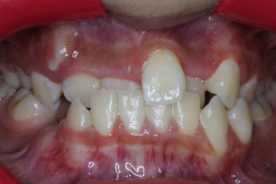 Before Braces: Negative overjet, overbite and severe crowding