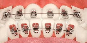 stb-lingual-braces Orthodontic information