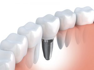 Dental Implants